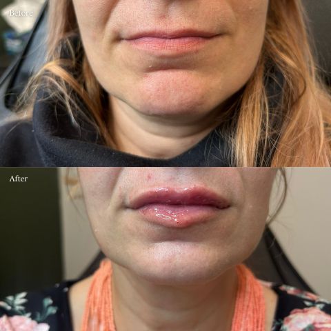 Lip Filler